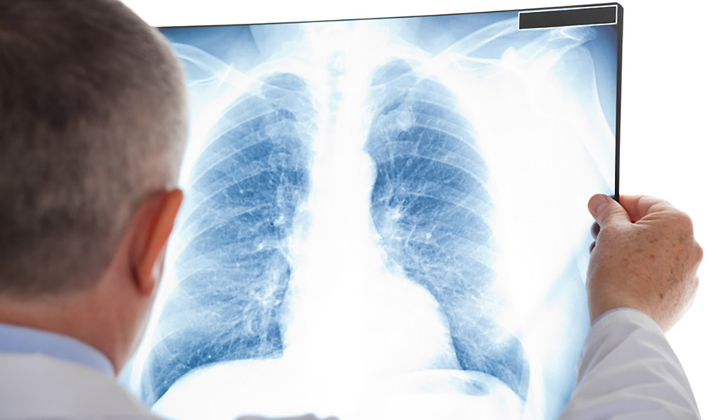 Röntgenbild der Lunge