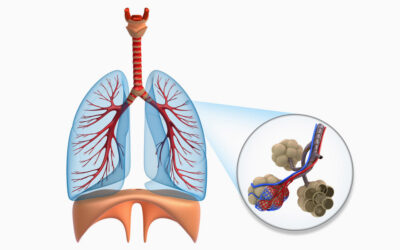 Lungenemphysem – Was ist ein Emphysem?
