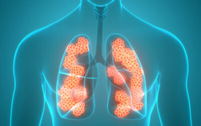 Lungenemphysem bei COPD – Was tun?