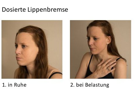 dosierte lippenbremse