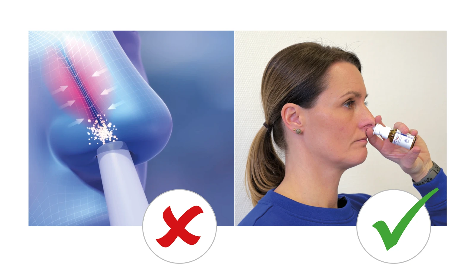 Die richtige Technik für die Anwendung von Nasenspray