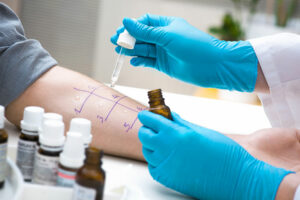 Ein Arzt mit blauen Handschuhen führt mit einer Pipette und einem markierten Raster einen Allergie-Hauttest am Unterarm eines Patienten durch.